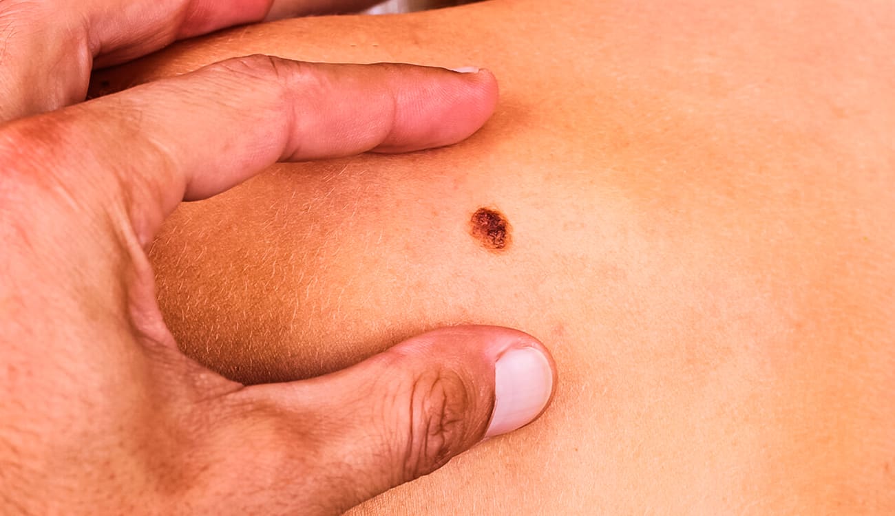 بشرى سارة لعلاج سرطان الجلد .. 7 علامات في جسدك تقودك إليه