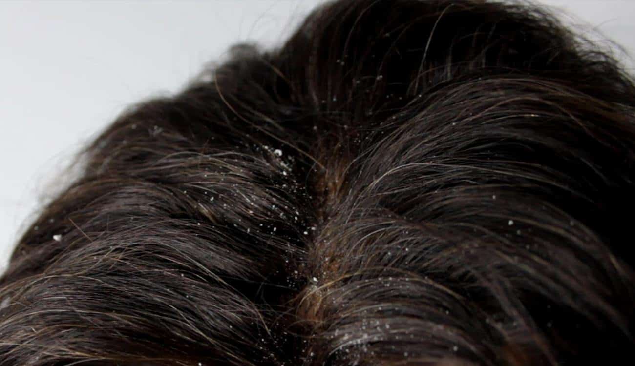 4 خلطات منزلية للتخلص من قشرة الشعر