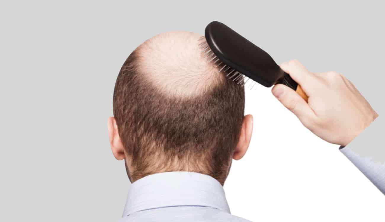 دراسة علمية: زراعة الشعر تخفف من الصداع المزمن!