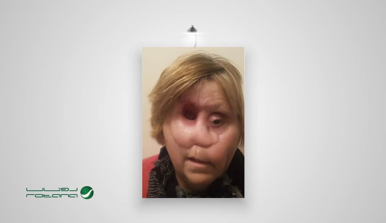 بالصور.. امرأة تتنفس من ثقب فوق تجويف عينها بسبب حالة مرضية نادرة!