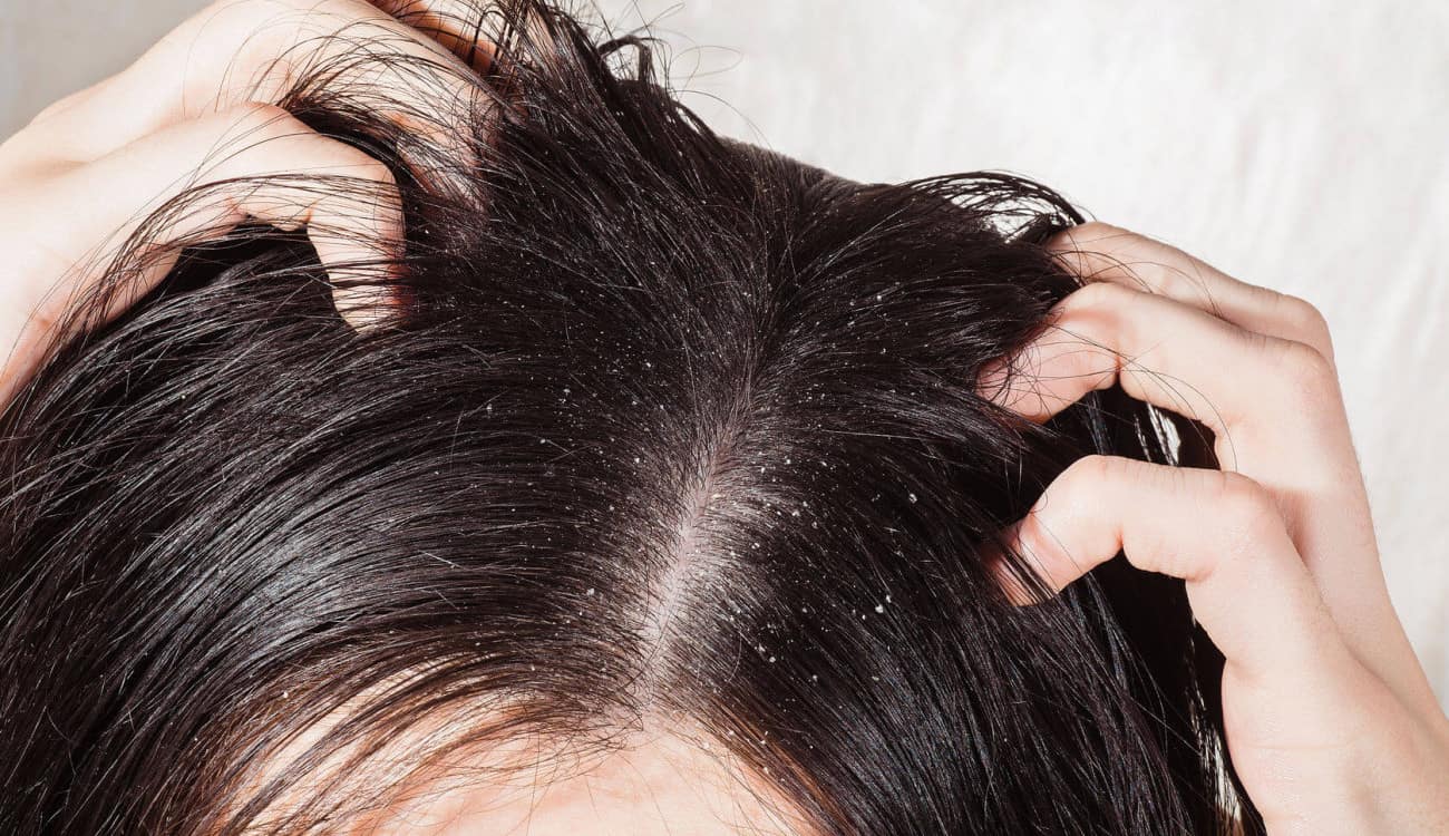 خلطة بيكربونات الصوديوم تخلصك من قشرة الشعر