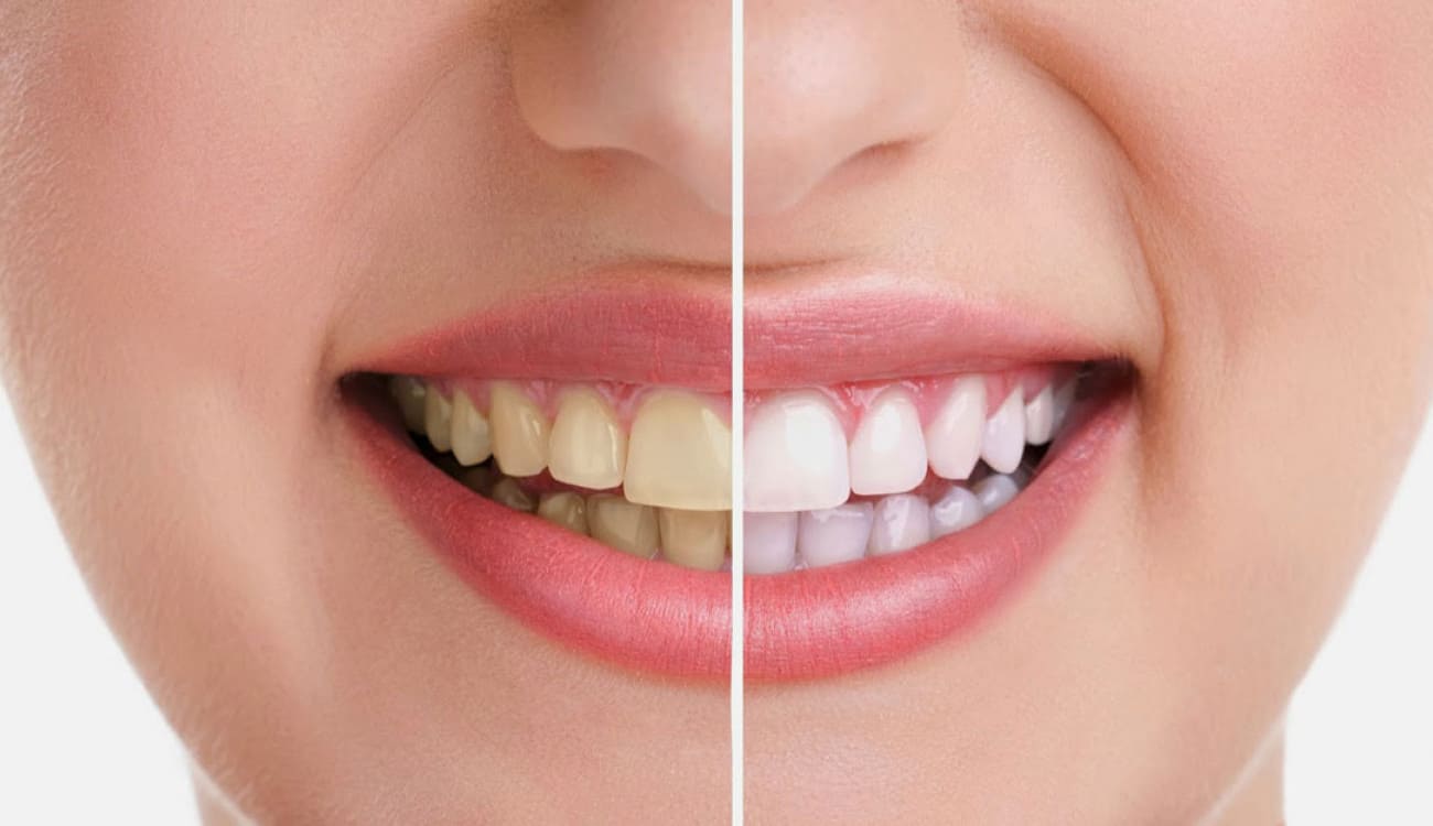 باحثون يحذرون من منتجات تبييض الأسنان: قد تضرها