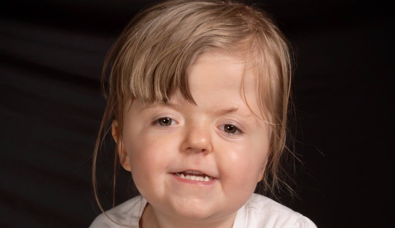 بالصور.. متلازمة "أبيرت" تشوه طفلة في السادسة وإنقاذها يحتاج 60 جراحة!