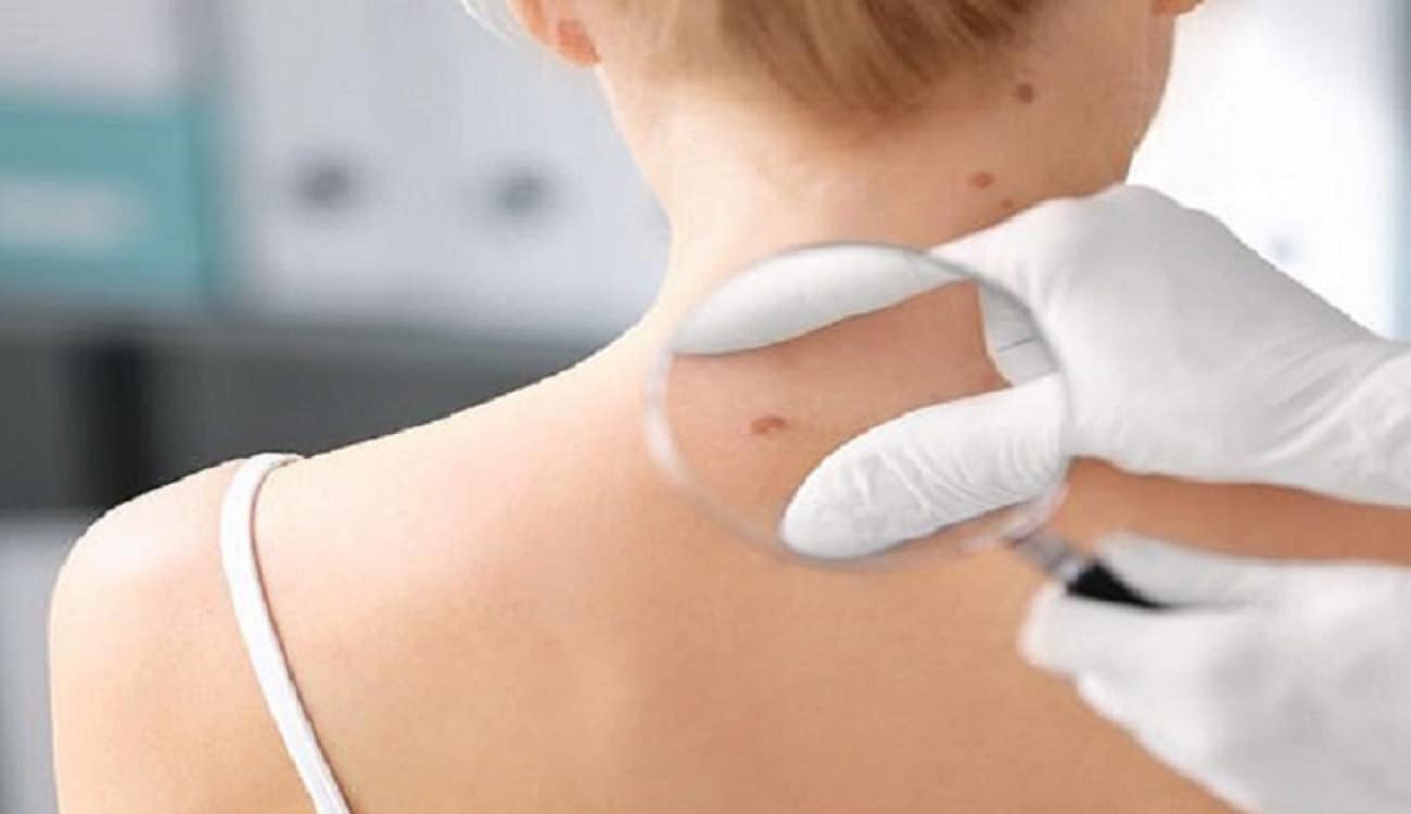 دراسة: الخطر الوراثي يشكل 74% من الإصابة بسرطان الجلد