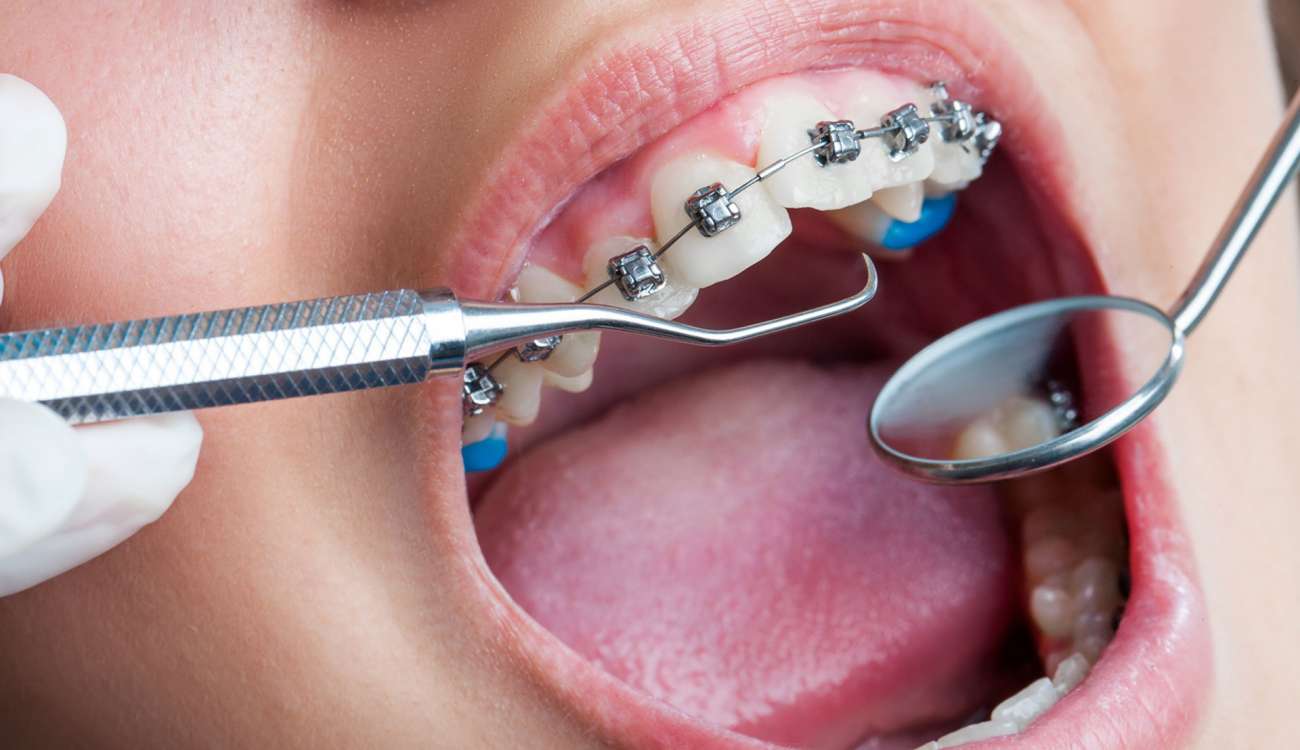 الصينيون يكتشفون حلا نهائيا لتسوس الأسنان